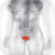 Bladder Cancer