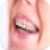 Braces App