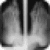 Bunion Surgery