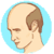 Alopecia Disease
