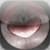 iLarynx