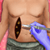 Liposuction Surgery- Fatty Body Laser Liposuction